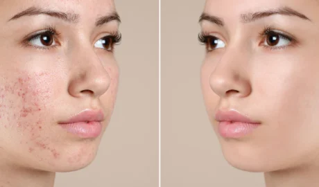 How to Get Better Skin ASAP